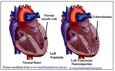 lv heart specialists|left ventricular non compaction symptoms.